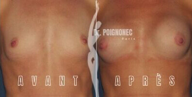Breast augmentation with new generation implants 7