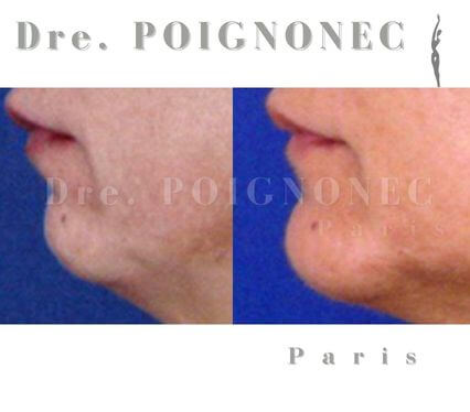 Chirurgie esthétique menton liposuccion menton ou génioplastie 2