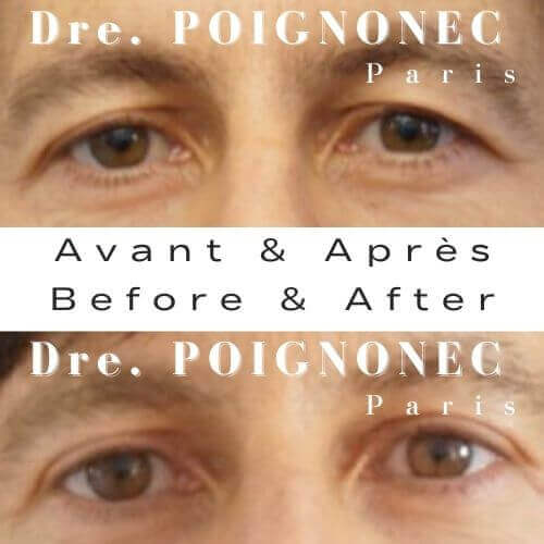 Chirurgie esthétique du regard 41