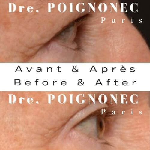 Blépharoplastie - Chirurgie des Paupières 6