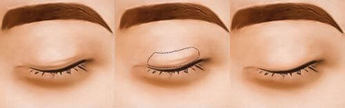 Aesthetic eye surgery 55