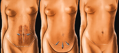 Mini-plastie abdominale 3