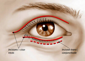 Blépharoplastie Incision des paupières Cicatrice Incision transconjonctivale