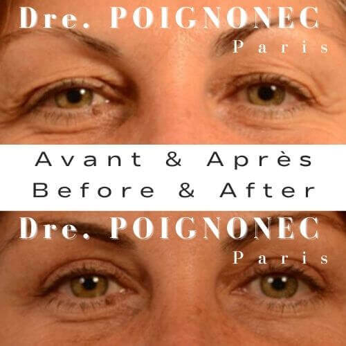 Avant et après chirurgie des paupières blépharoplastie