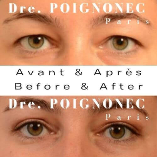 Blépharoplastie - Chirurgie des Paupières 4