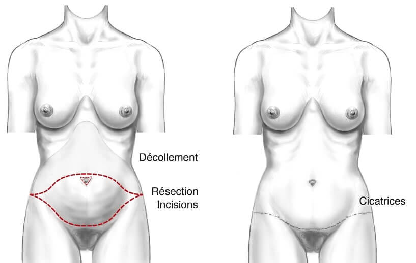 Mini-plastie abdominale 4