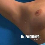 Breast augmentation with underarm implants