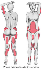 Liposuccion lipoaspiration 9