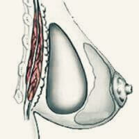 Augmentation Mammaire Nouvelle Génération 3