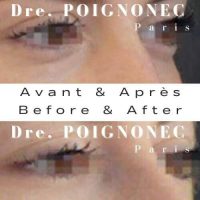 Contour des yeux esthétique avant après sans chirurgie – Tous droits réservés Dr. POIGNONE©