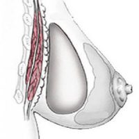 disposition implant mammaire retroglandulaire ou pre musculaire disposition pré-musculaire rétro-glandulaire
