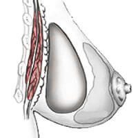 Anterior alignment of the retroglandular (premuscular) muscles