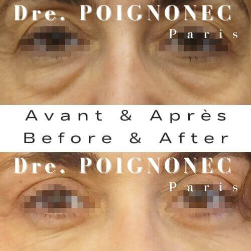 Blépharoplastie - Chirurgie des Paupières 2