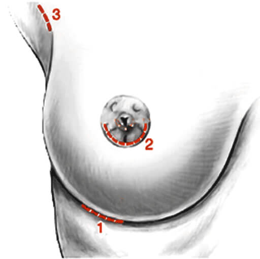 Breast augmentation with new generation implants 15