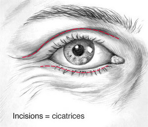 Blépharoplastie - Chirurgie des Paupières 7