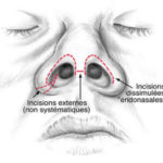 Rhinoplastie 3