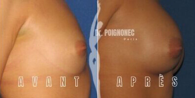 Breast augmentation with new generation implants 8