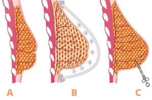 Lipofilling mammaire 1