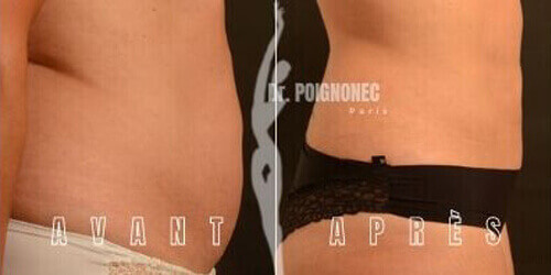 Avant et après plastie de l'abdomen