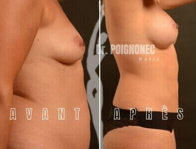 Breast augmentation with new generation implants 1