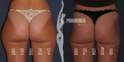 Liposuccion lipoaspiration 5