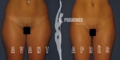 Liposuccion lipoaspiration 4