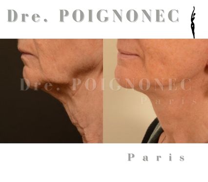 Rajeunissement bas du visage 38