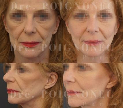 Avant et après mini lifting visage mini lift facial