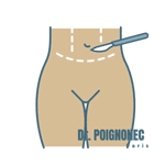 Mini-plastie abdominale 2