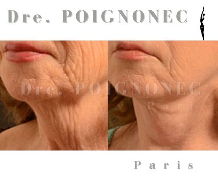 Rajeunissement bas du visage 40