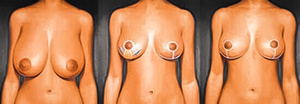Réduction mammaire 1
