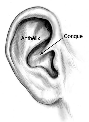 Oreilles décollées : Otoplastie 4