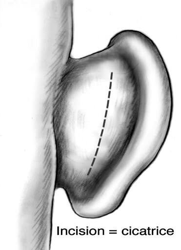 Oreilles décollées : Otoplastie 5