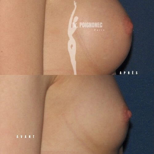 Augmentation mammaire 13