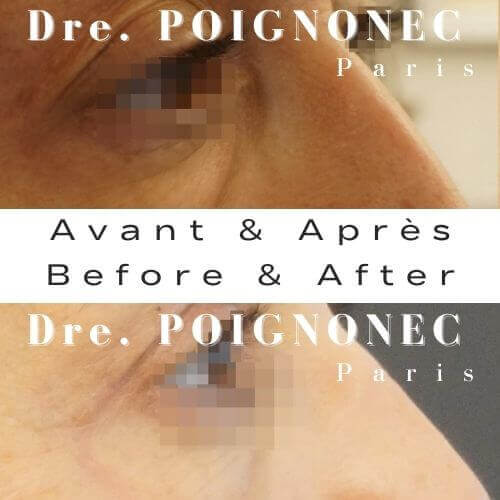 Blépharoplastie - Chirurgie des Paupières 3