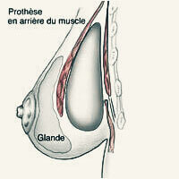 Augmentation Mammaire Nouvelle Génération 2