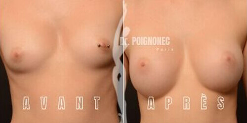 Avant et après augmentation mammaire