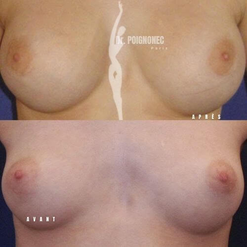 Breast augmentation with new generation implants 5