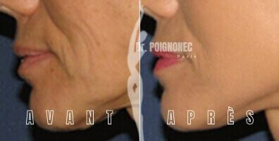 Chirurgie lifting cervico facial copyright dr. Poignone©