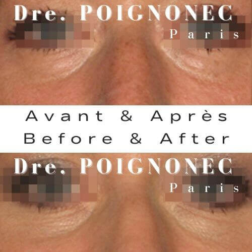 Blépharoplastie - Chirurgie des Paupières 13