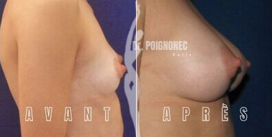 Breast augmentation with new generation implants 9