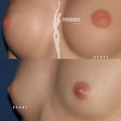 Augmentation mammaire 12