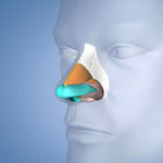 Rhinoplastie 8