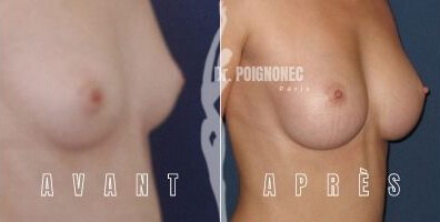 Breast augmentation with new generation implants 6