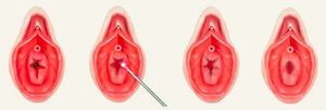 Chirurgie de l'hymen à Paris